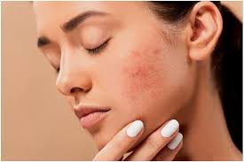 Acne in winter