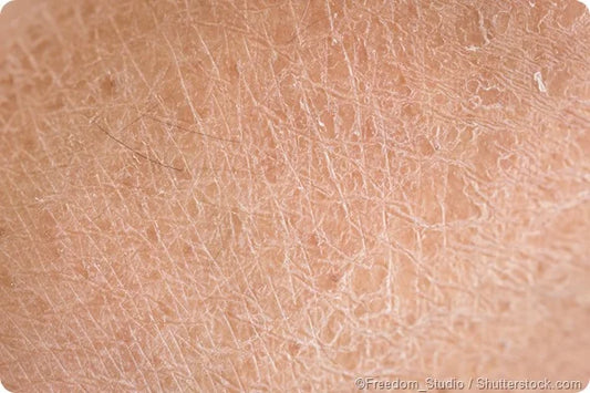 Dry Skin Ends with a Humidifier